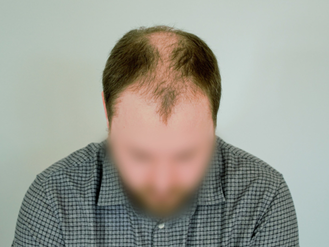 Hair transplants in Berlin - Affordable and quality treatments